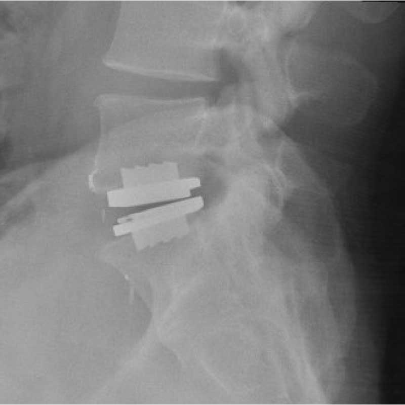 LumbarArthroplasty.jpg