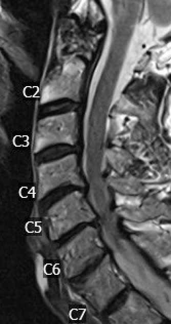 Cervical-stenosis-pre-op-MRI.jpg