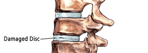 degenerative-disc.gif