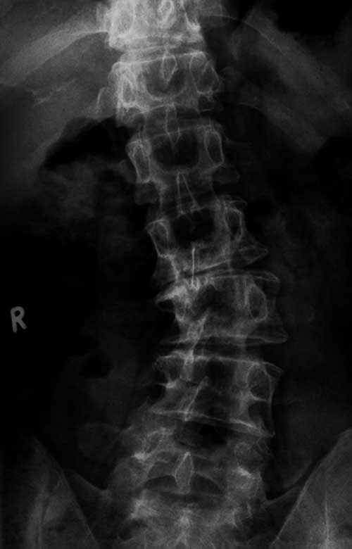 Adult-Scoliosiis.jpg