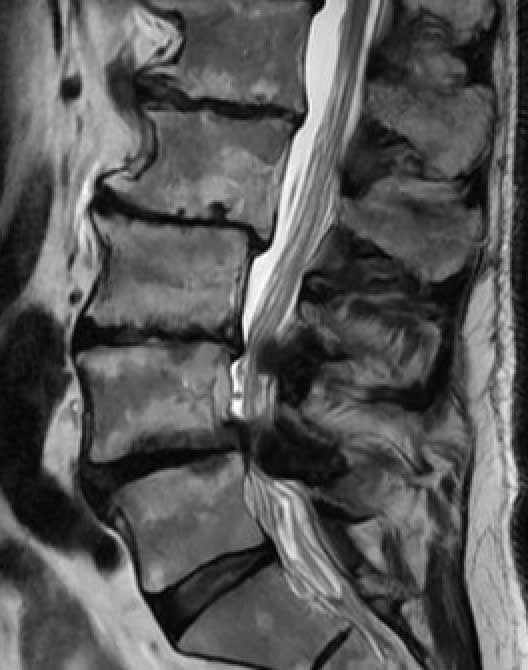 Screenshot-LumbarStenosis-JG1.jpg