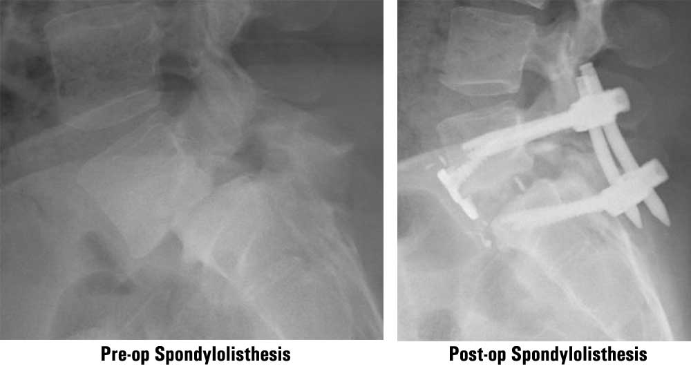 SpondylolisthesisSurgery.jpg