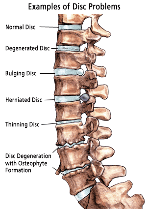 degen_disc_types_label_illus51.gif