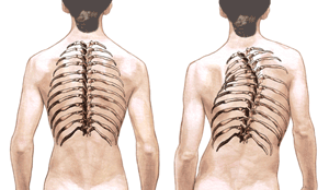 scoliosis_illus100.gif