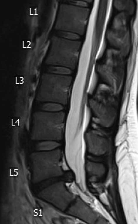 Lumbar-disc-herniation.jpg