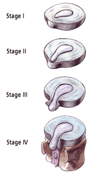 The Stages of a Disc Herniation.